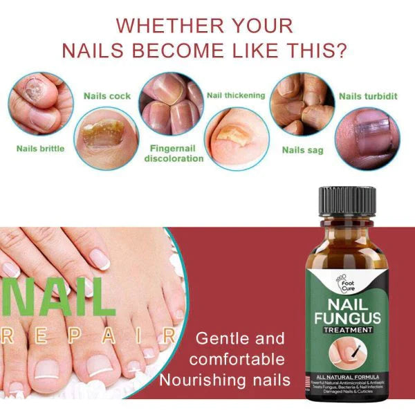 Nail Fungus Treatment